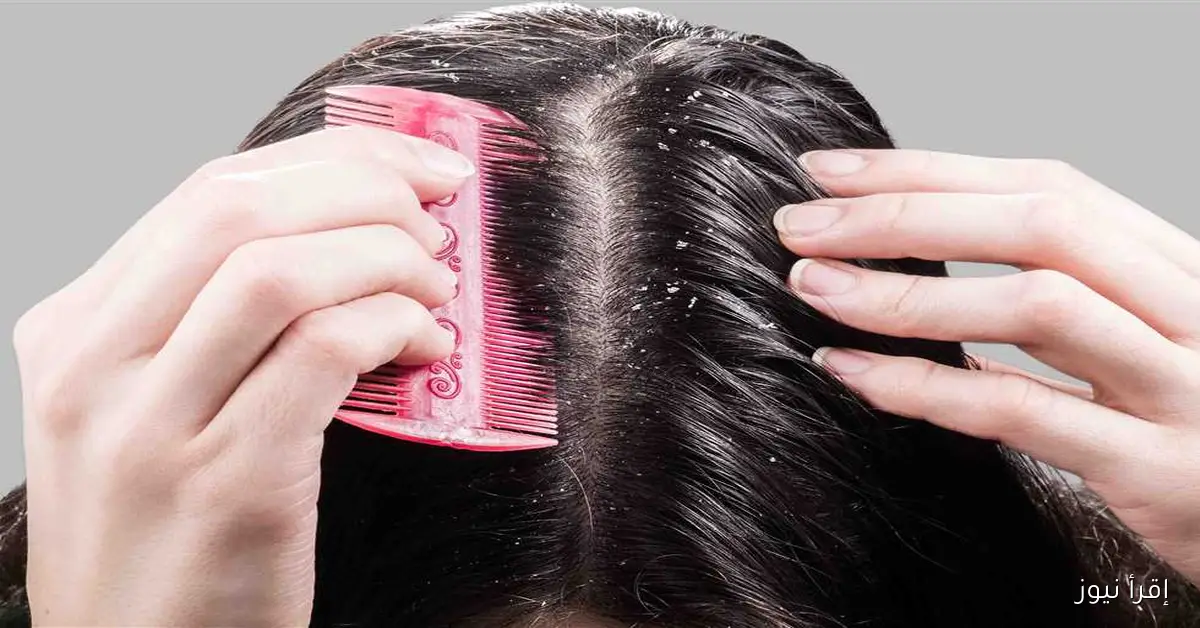 خلال أسبوع واحد: 5 نصائح فعالة للتخلص من قشرة الشعر