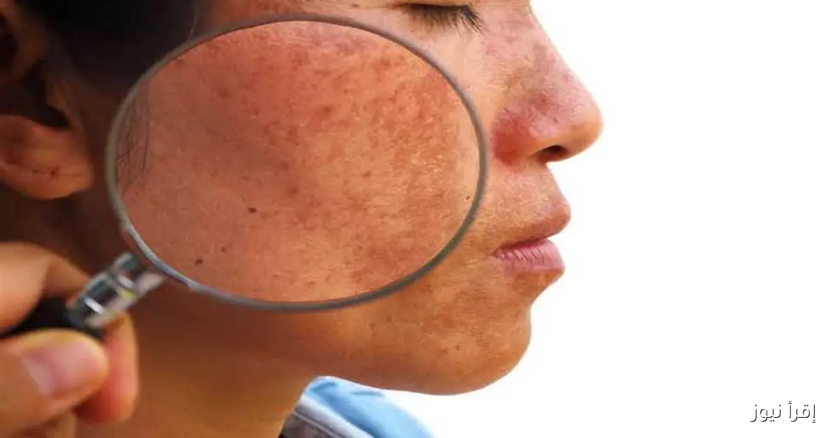 طرق سهلة لعلاج كلف الحمل في المنزل دون عناء