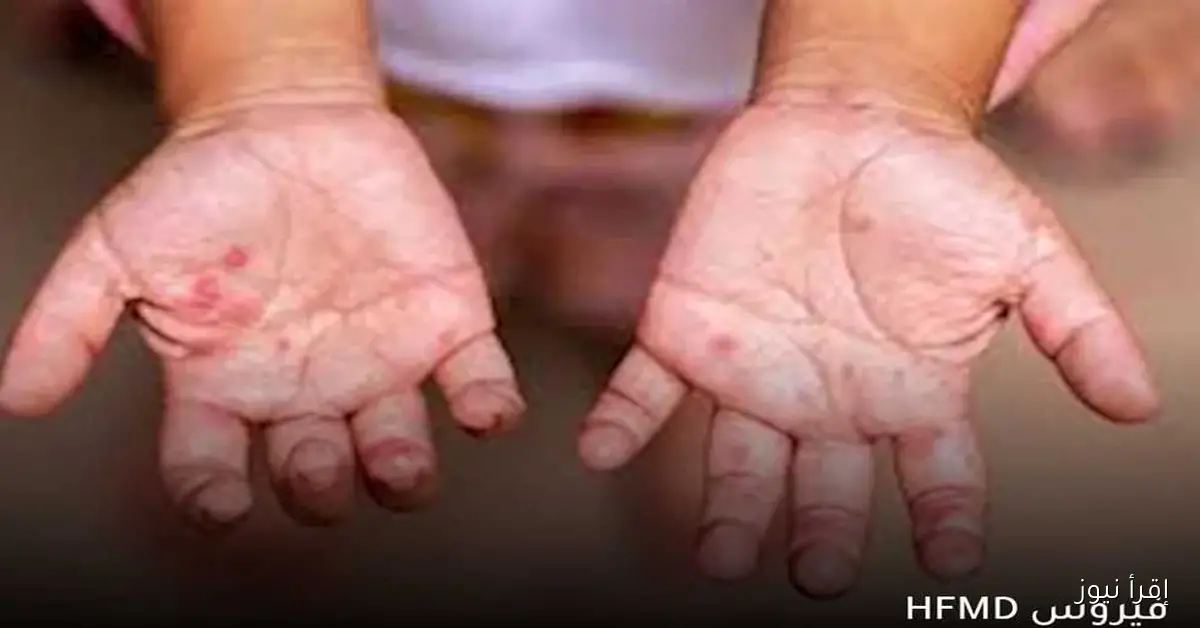 ظهور 4 حالات مصابة بفيروس HFMD: متى يجب عليك زيارة الطبيب؟