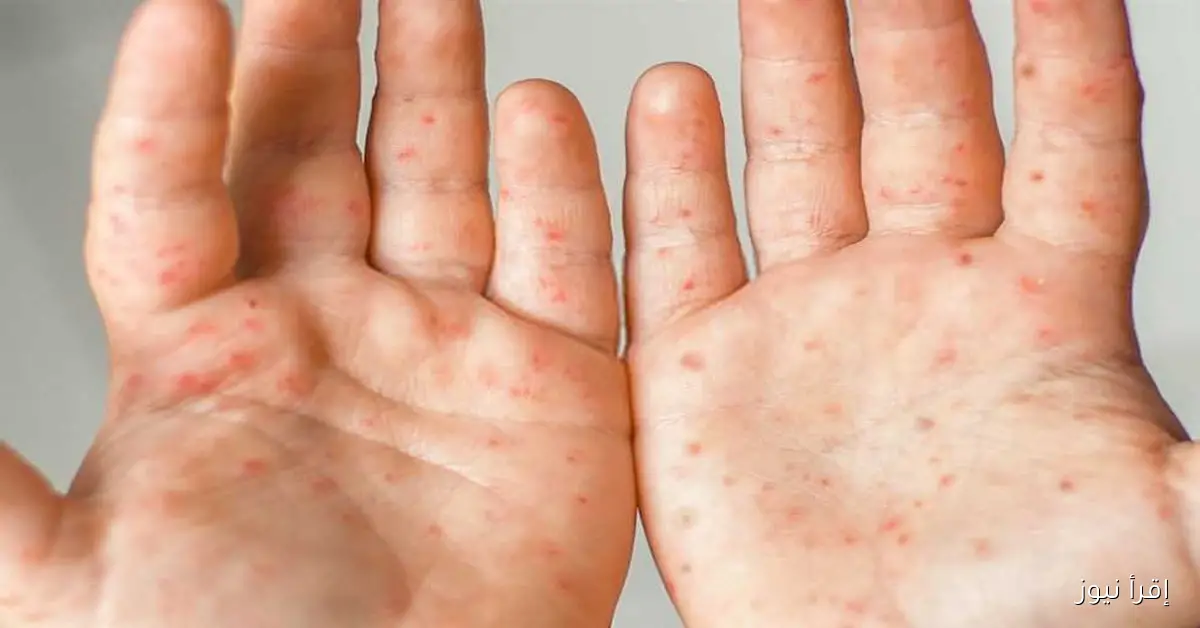 كيف تساعد ابنك المصاب بفيروس HFMD على التعافي بسرعة