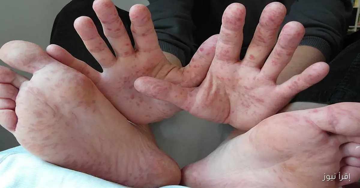 مرض اليد والقدم والفم: تعرف على أعراضه وأسبابه وكيفية وقاية الأطفال منه
